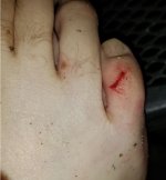 Bitten.JPG
